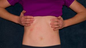 Comment fermer son bassin après l'accouchement? Exercice pour les côtes