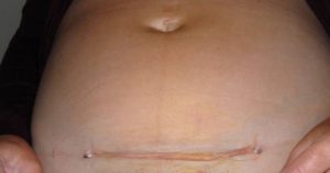 c section or caesarian section scars after pregnancy